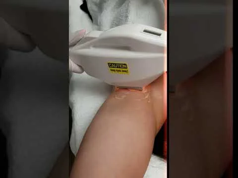 Laser Hair Removal Underarm
