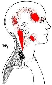 Cervical Spine Trigger Point Treatment — CAP Physical Therapy