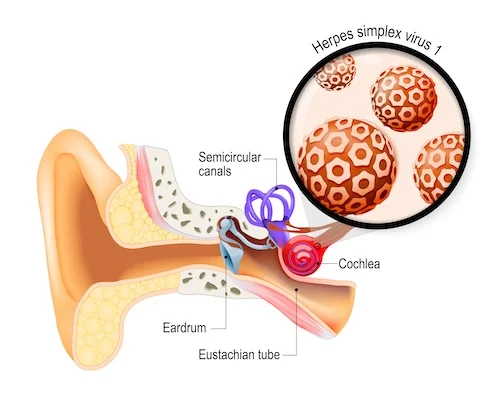 labyrinthitis.jpg