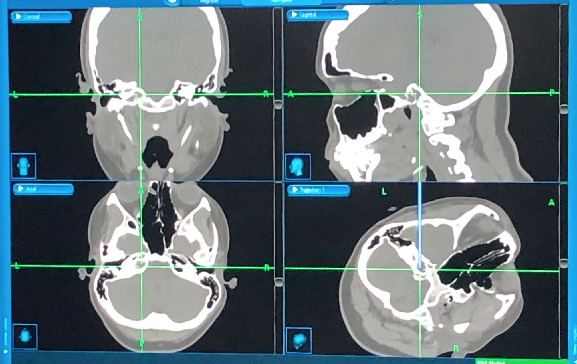 cholesterol granuloma