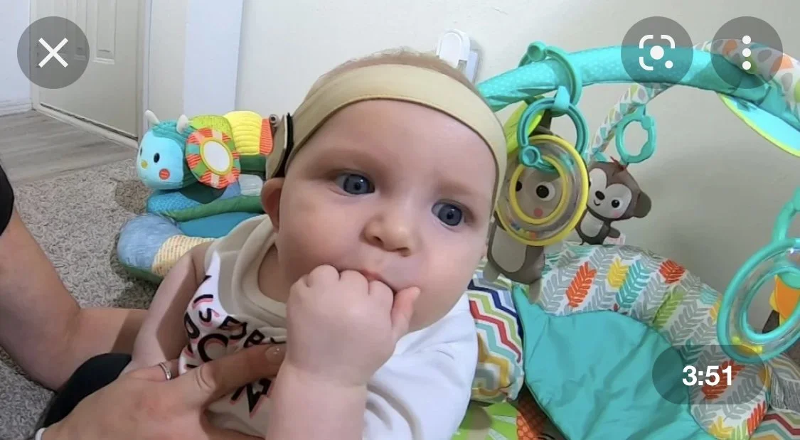 youngest cochlear implant