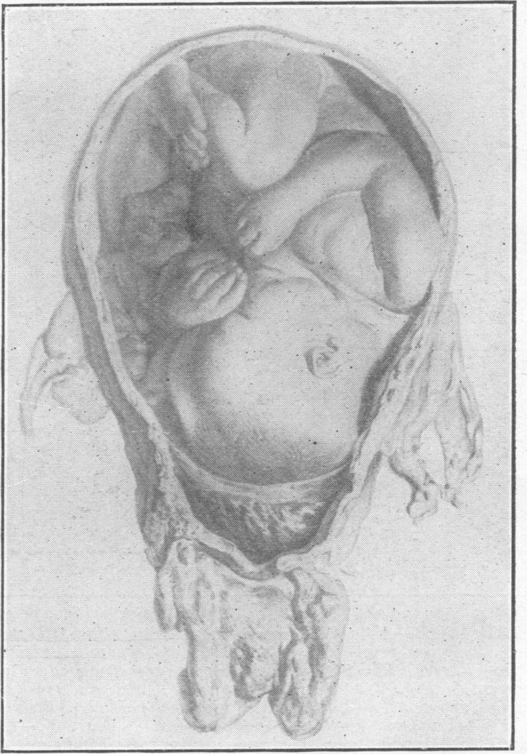 1774- Fetus in the Womb- William Hunter3.jpg