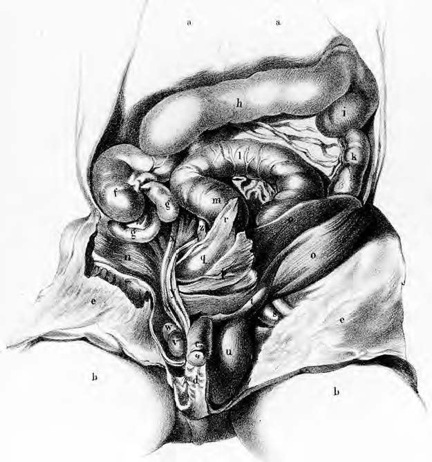 1796- Disscection of a fetus about seven month old- John Hunter.jpg