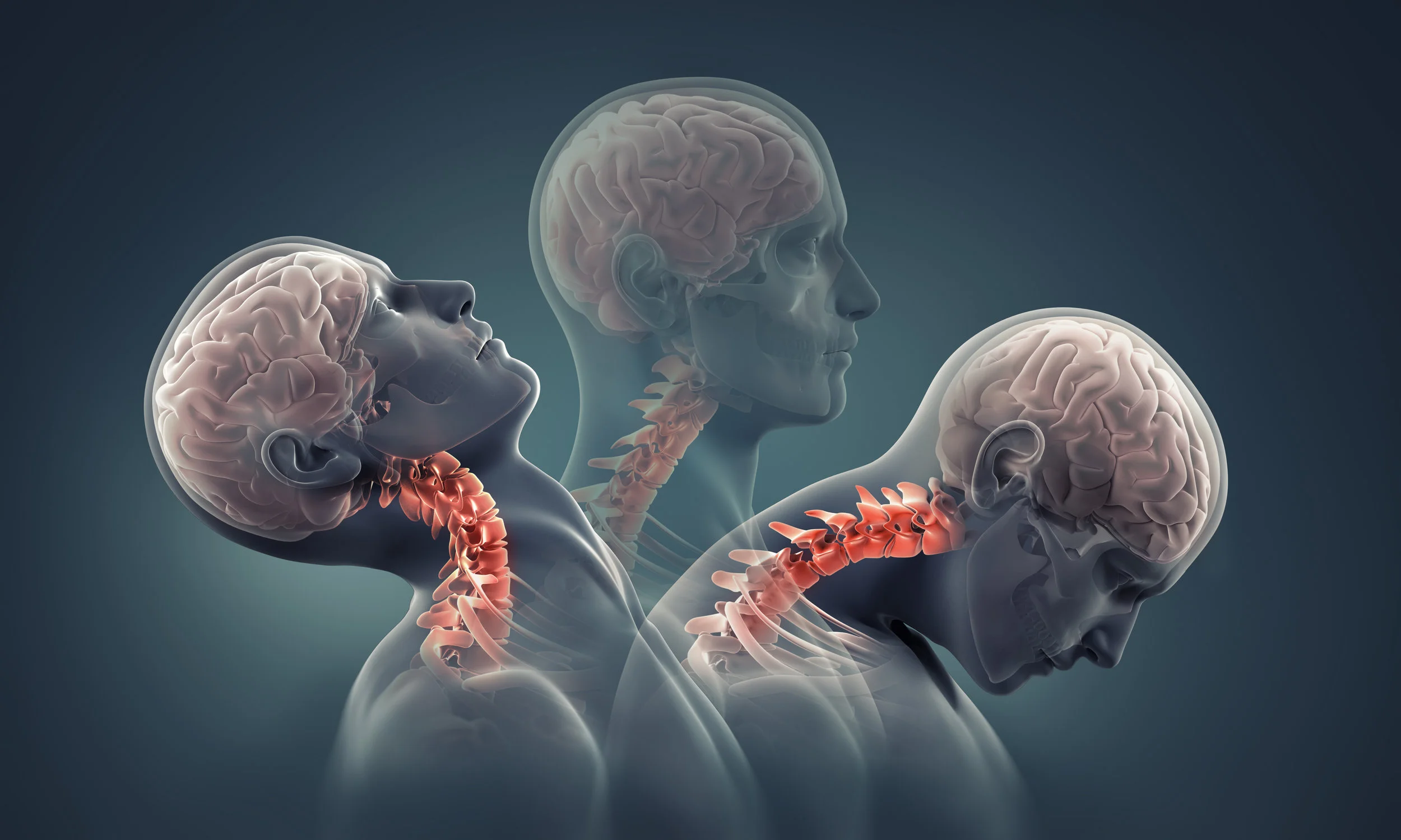 Whiplash Injury &amp; Whiplash Associated Disorder