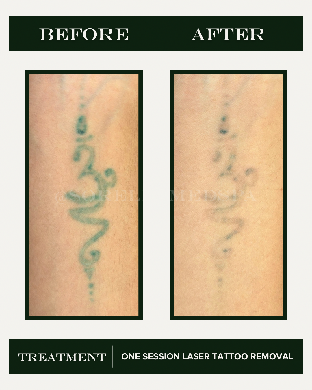 tattoo removal denver south.PNG
