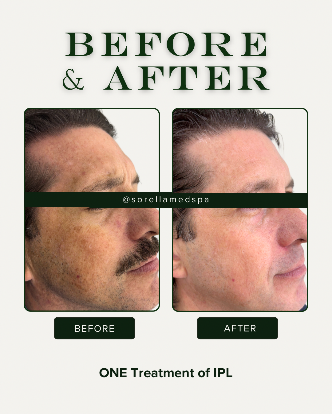 Lone Tree IPL Lumecca