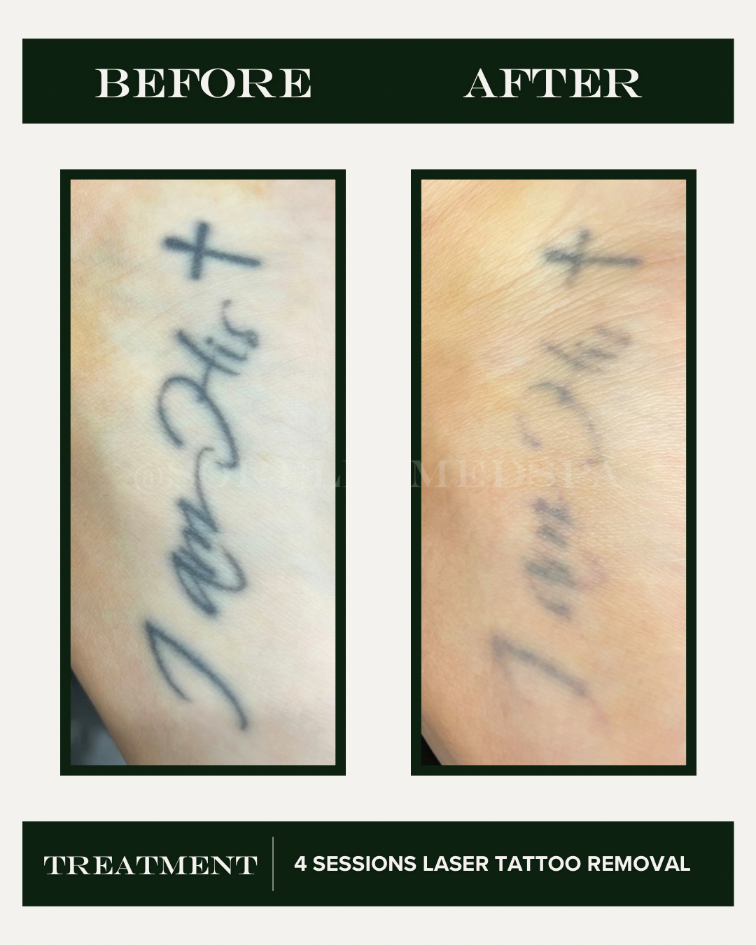 Pico Laser tattoo removal Denver