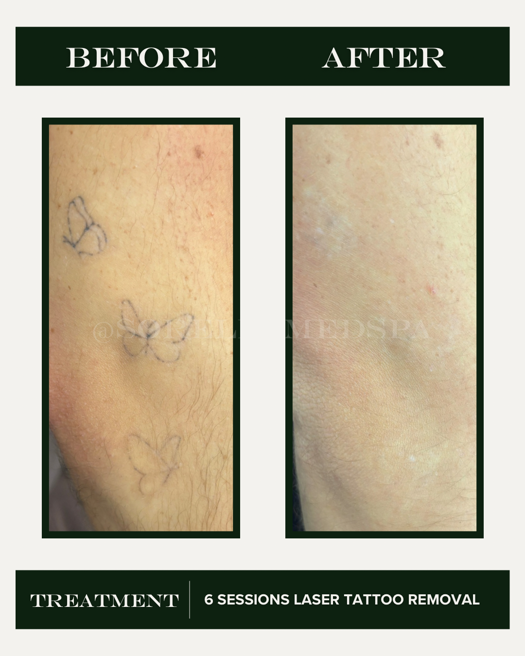 picosure pro laser tattoo removal denver.PNG