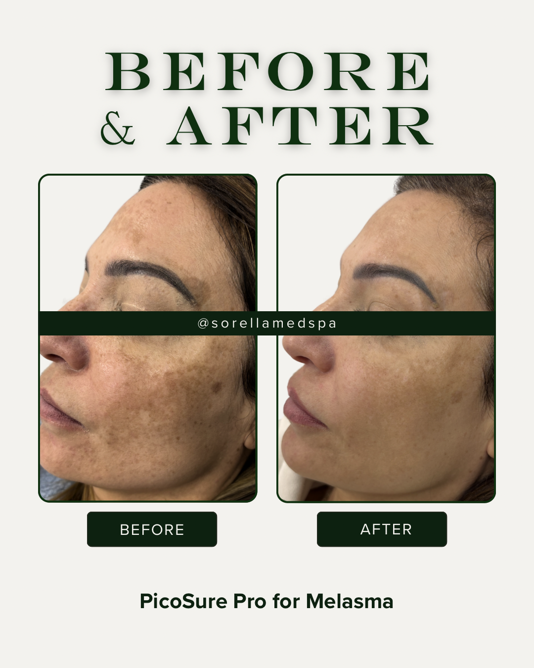 Best Laser for Melasma in Denver (Safe and Effective Options)