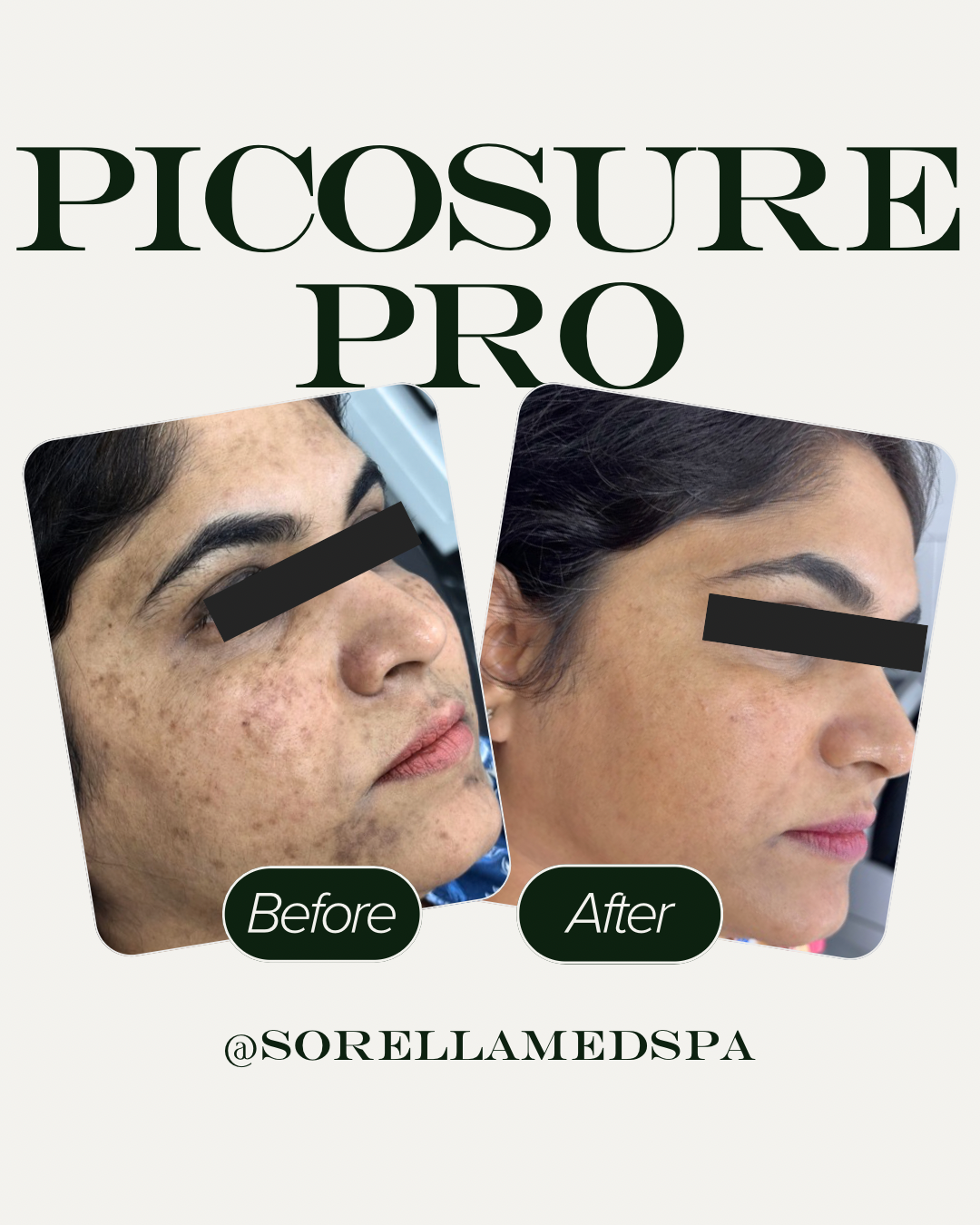 picosure pro pico laser denver