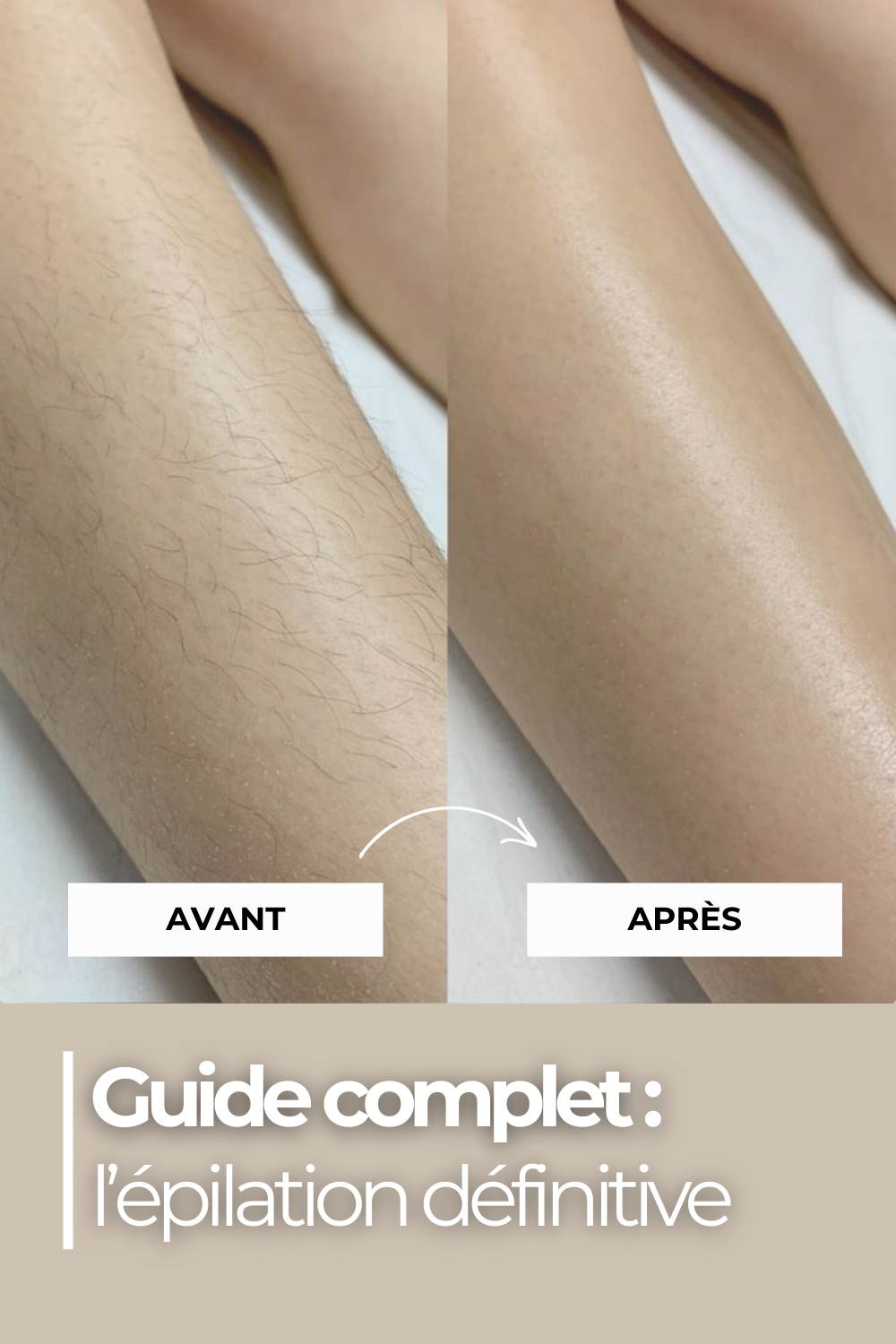Guide complet 2025 de l’épilation laser définitive : tout ce que vous devez savoir