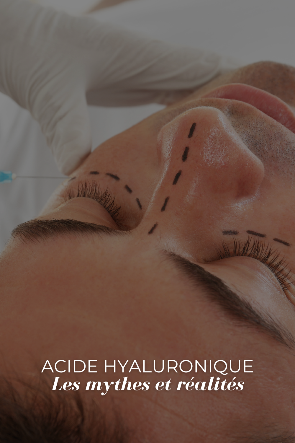 Les Injections d’Acide Hyaluronique : Mythes et Réalités Dévoilés