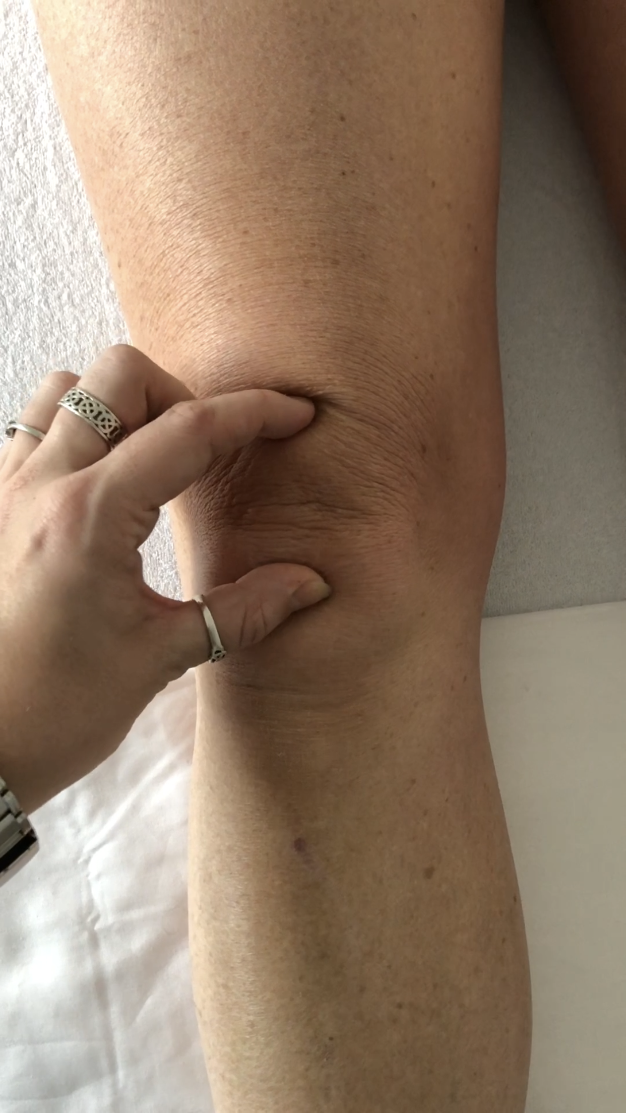 Acupuncture Brockley