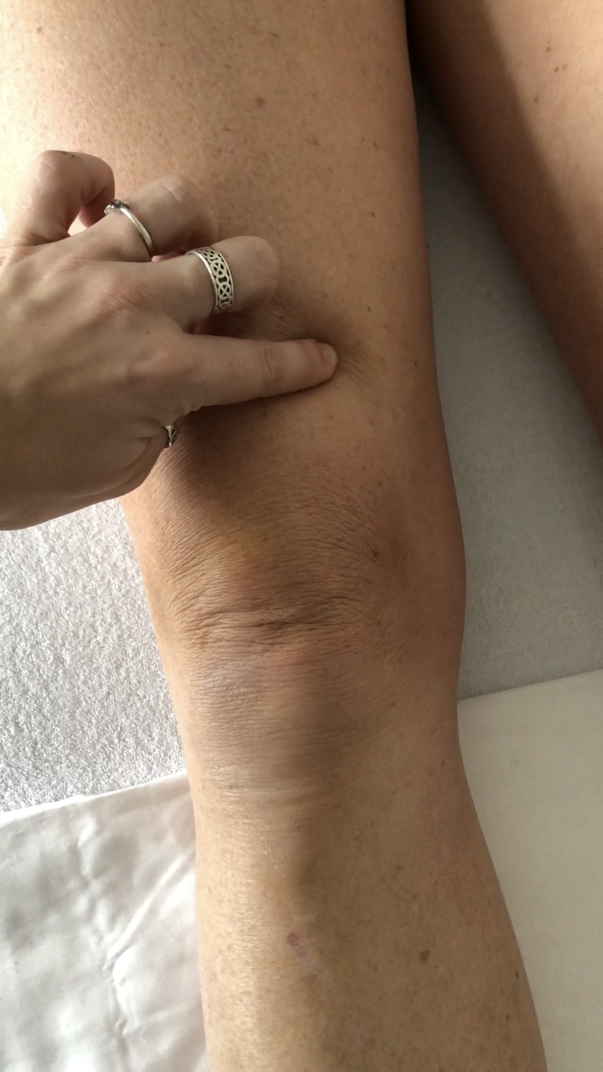 Acupuncture South East London