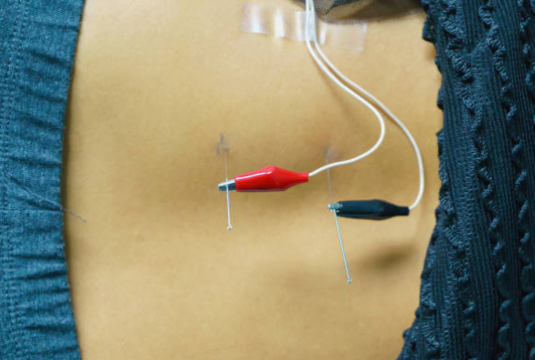 Electro‑Acupuncture for Poor Ovarian Response in IVF