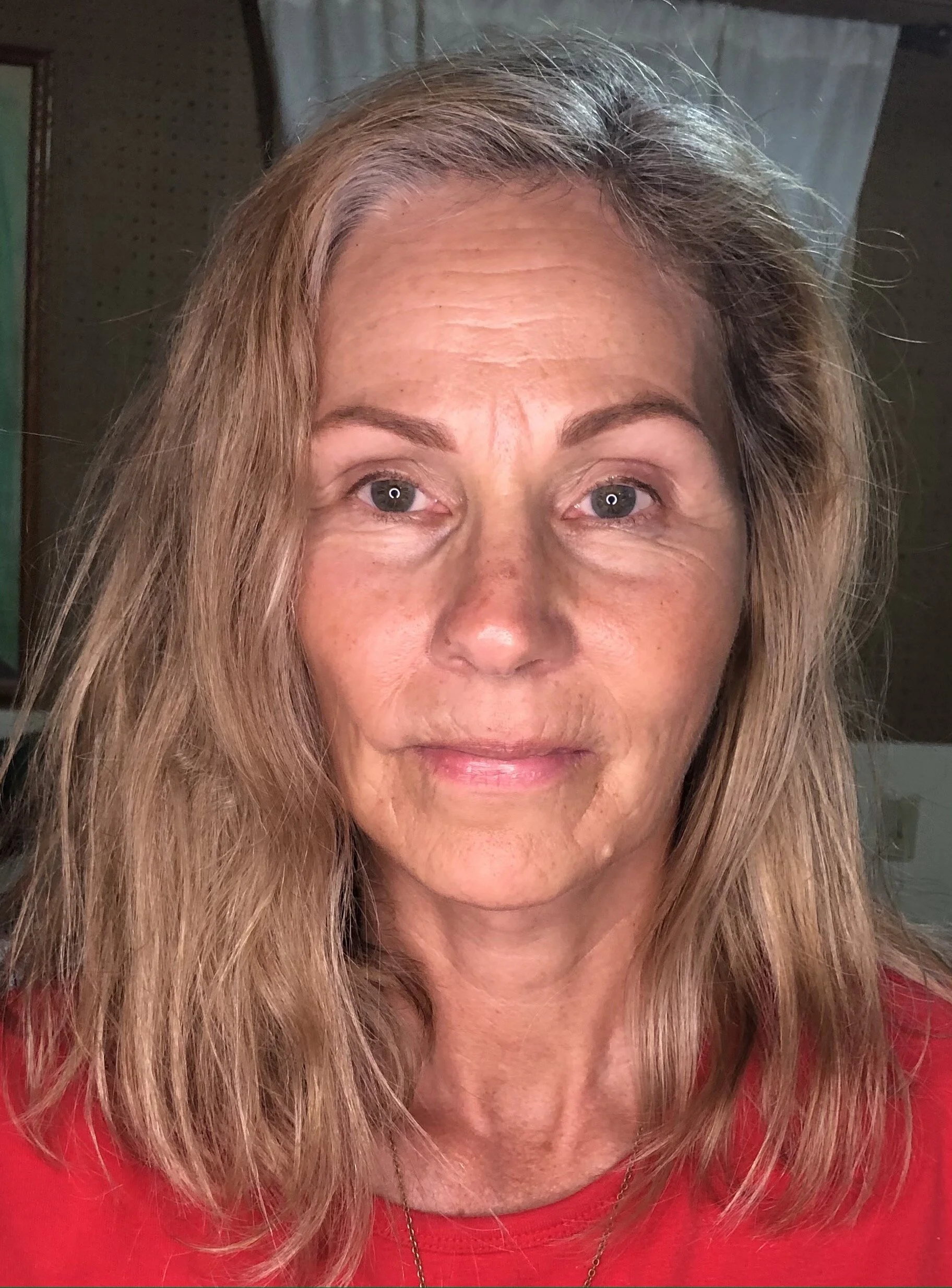 FACELIFT POST-OP:  One Month Follow-Up