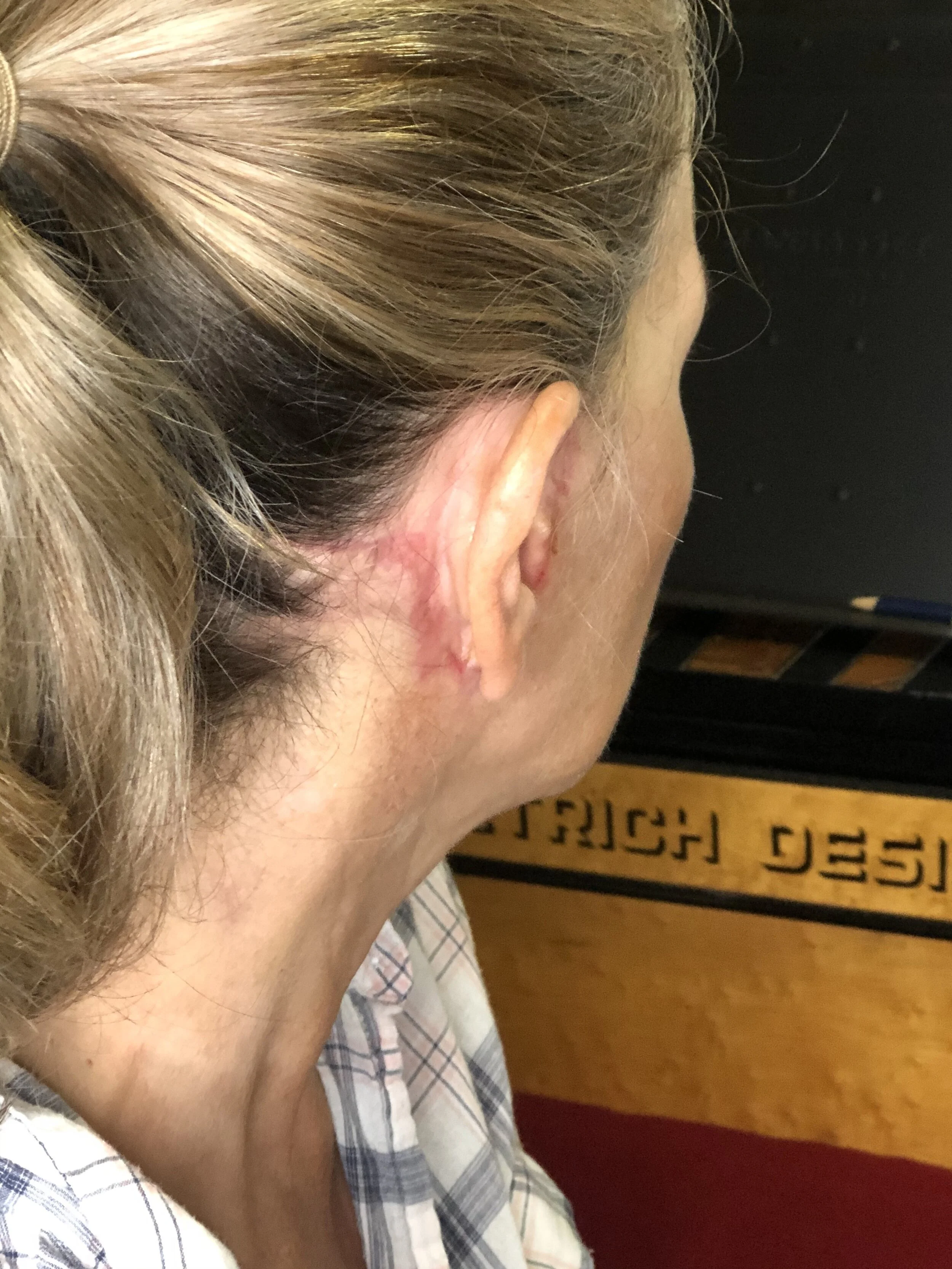 High ponytails are still out.  I now sport a “phoney-tail”,  a low version of a ponytail with loose tendrils strategically (I mean winsomely) placed both in front of and behind each ear.  At least the scabs have mostly fallen off..