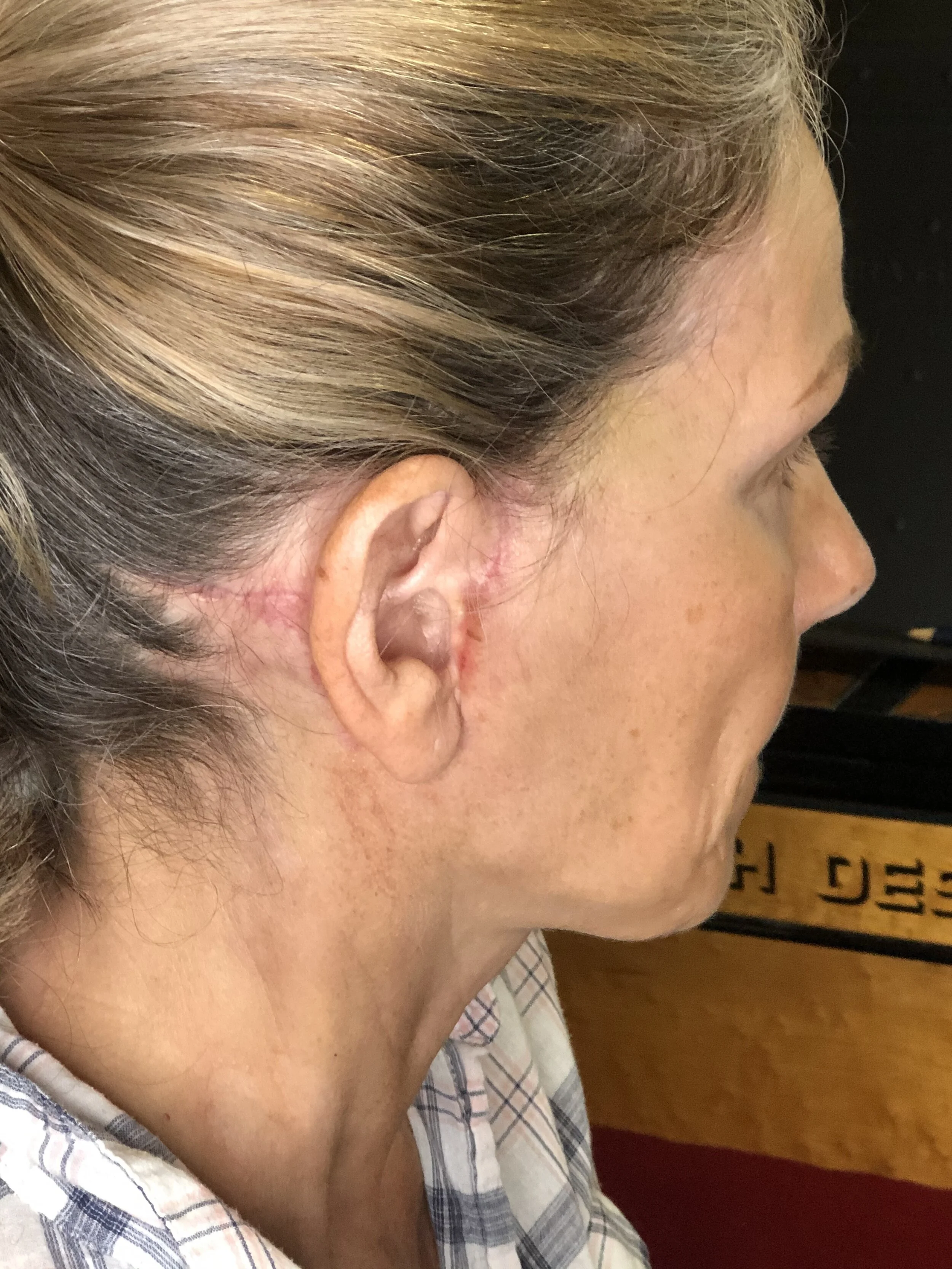 Right ear:  This side was less traumatized by the surgery, and consistently healed faster and felt better.  I’ve read that uneven healing is fairly common, but if you have concerns make sure to share them with your surgeon.  (A reminder this weblog reflects my personal experience, and is shared for entertainment).