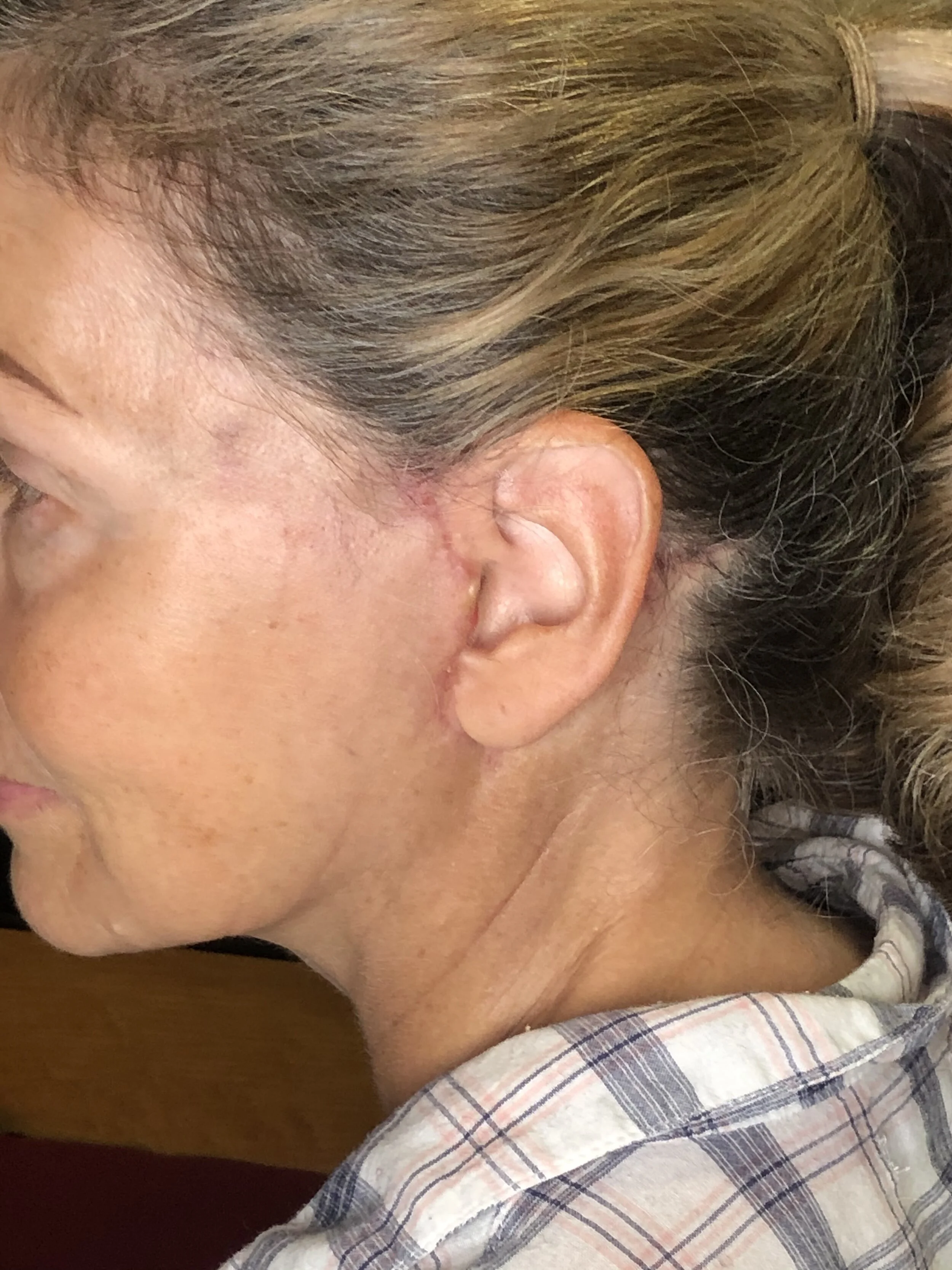 Left ear - still significant bruising around the temples, and fresh scars Frankenstein himself would appreciate.