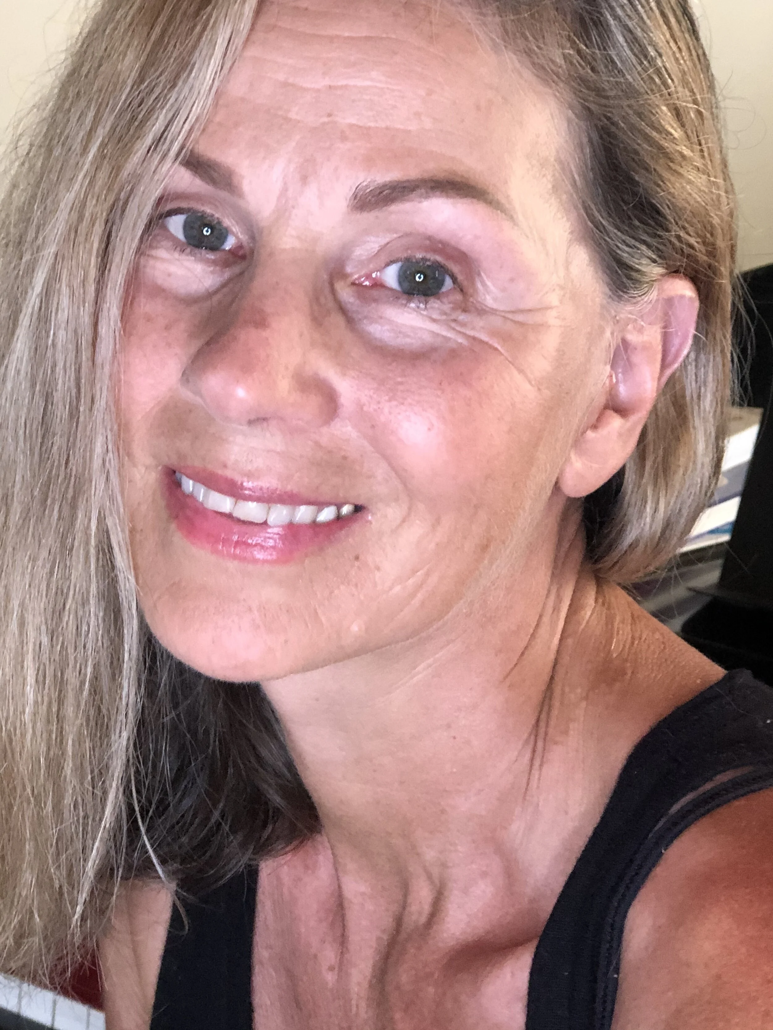 FACELIFT POST-OP:  Week 8