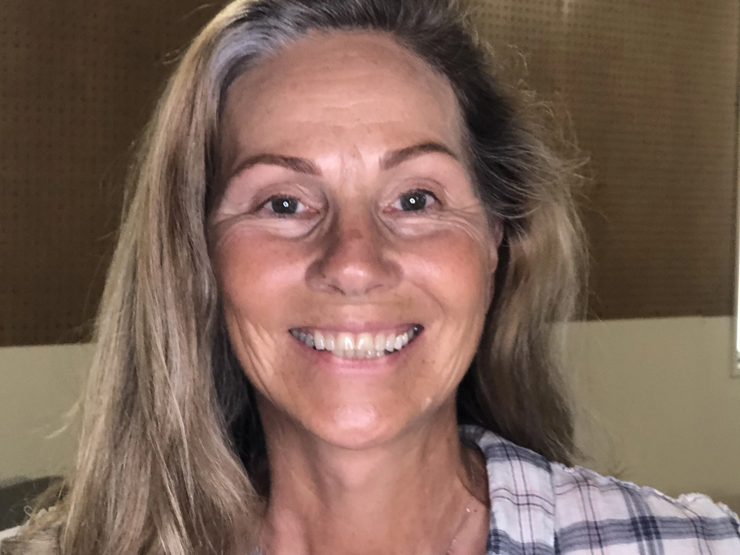 FACELIFT POST-OP:  10-11 Weeks Later