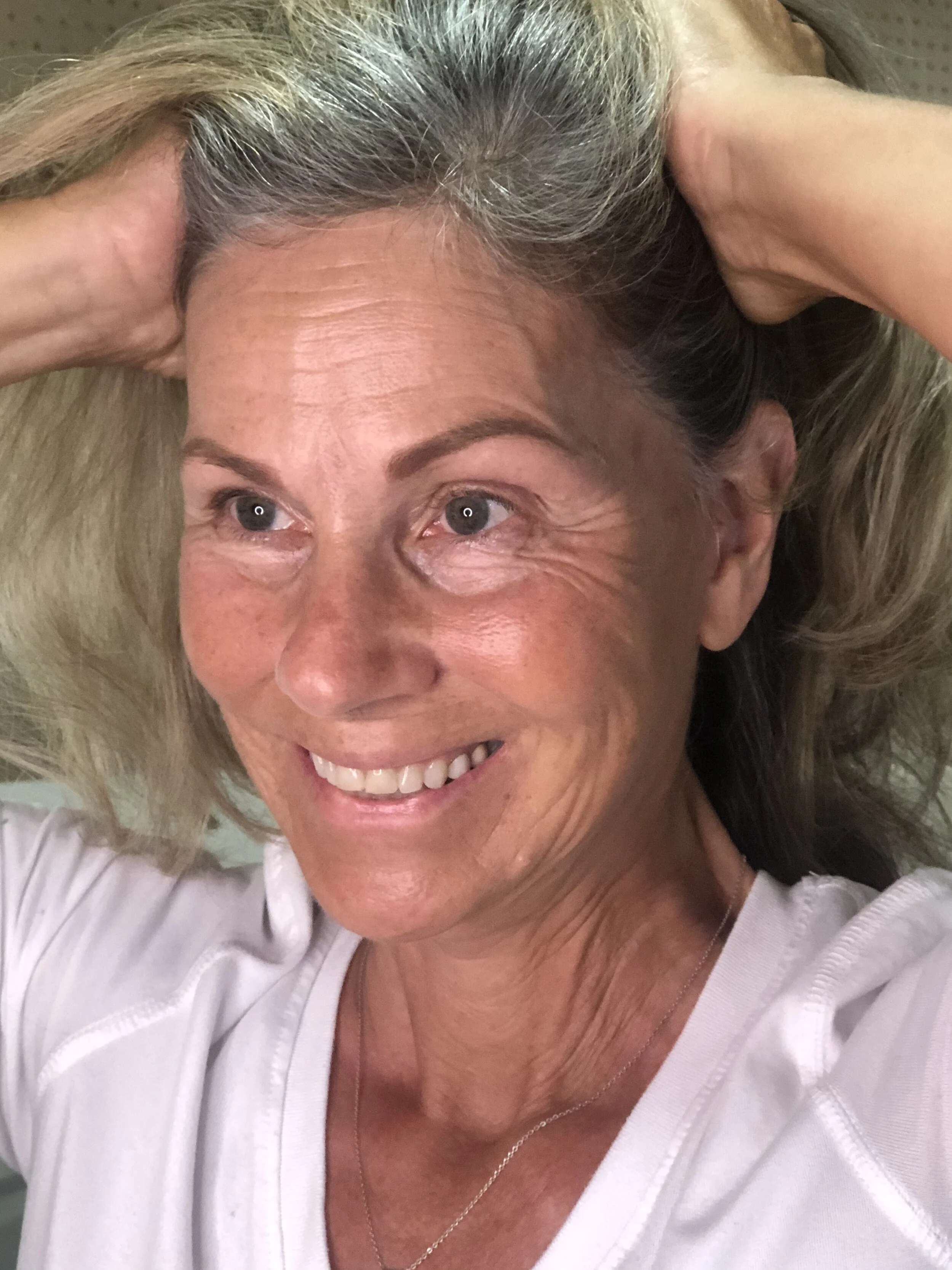 FACELIFT POST-OP:  Week 12