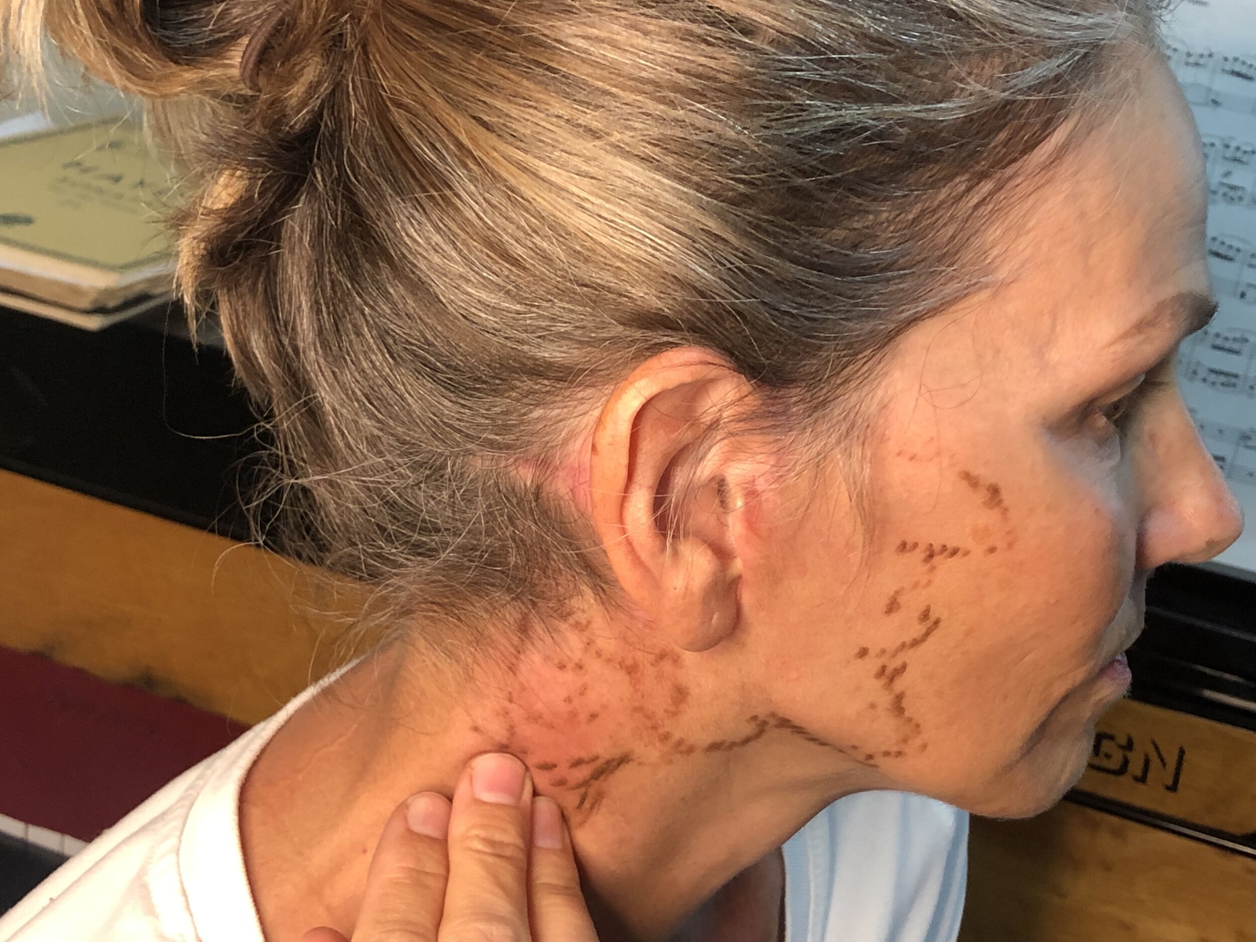 FACELIFT POST-OP:  5 Months Later - and my first Post Op ACTING JOB!