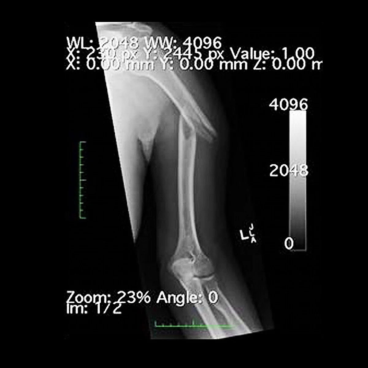 Keith Auerbach : Ann's Broken Arm