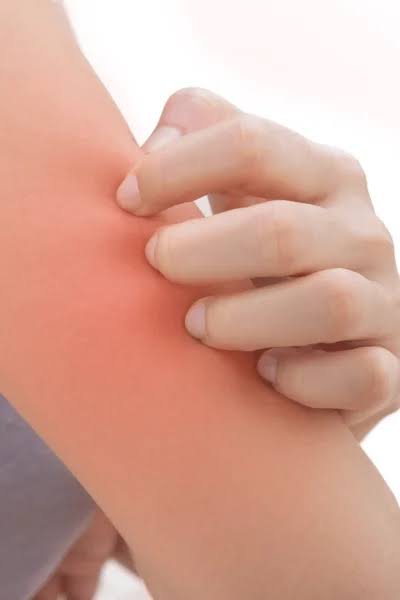 Mast Cell Activation Syndrome (MCAS): Why Exercise Feels So Hard — and How to Rebuild It Safely