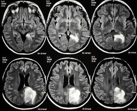 MRI scan showing Axial cut of the brain, with a left parietal glioblastoma, which is not linked to MS but shown for demonstrative purposes.
