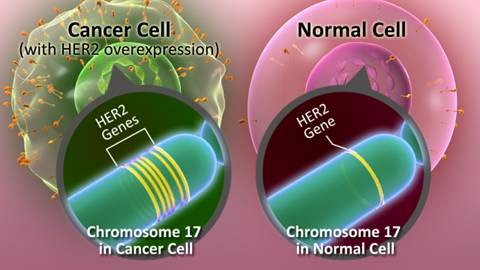 A (basic) representation of the over-expression of chromosome 17 on the HER2 gene when mutated, which the basis of its cancerous consequences. Credit: CancerResearch UK, Breastcancer,org, Fda.org via CiteThisForMe
