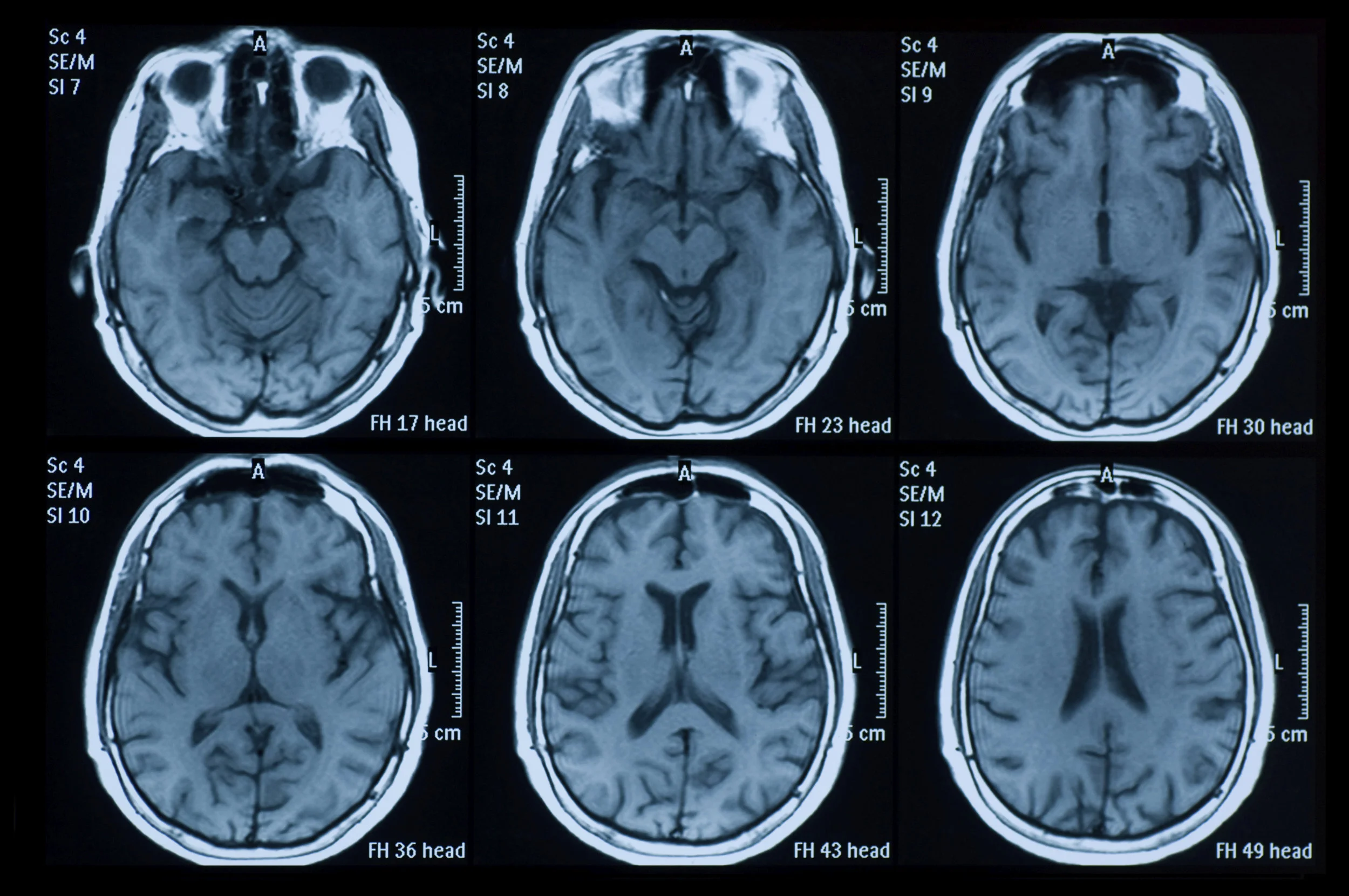 SNAC To Use Artificial Intelligence for Brain Scan Imaging