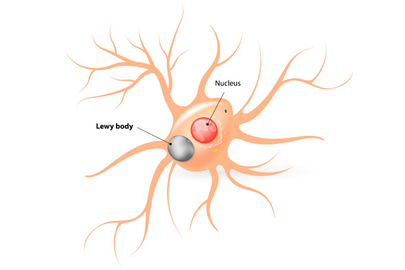 Lewy Body Dementia (LBD), is estimated to effect approximately 1.4 million Americans. LBD includes patients from both dementia with Lewy bodies and Parkinson’s disease dementia diagnoses. People with LBD often experience the same symptoms as Alzheimer’s patients, in addition to sleep disturbances, visual hallucinations, muscle rigidity or other Parkinsonism physical and cognitive impairments.