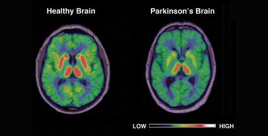 These kinds of diseases takes place when nerve cells are unable or lacks to produce brain chemical called ‘dopamine’. Neurons are the functional units of brain; when they are unable to response then such disorders can also occur. It can be due to nervous weakness, blockage of veins, diabetes disorders and many more.