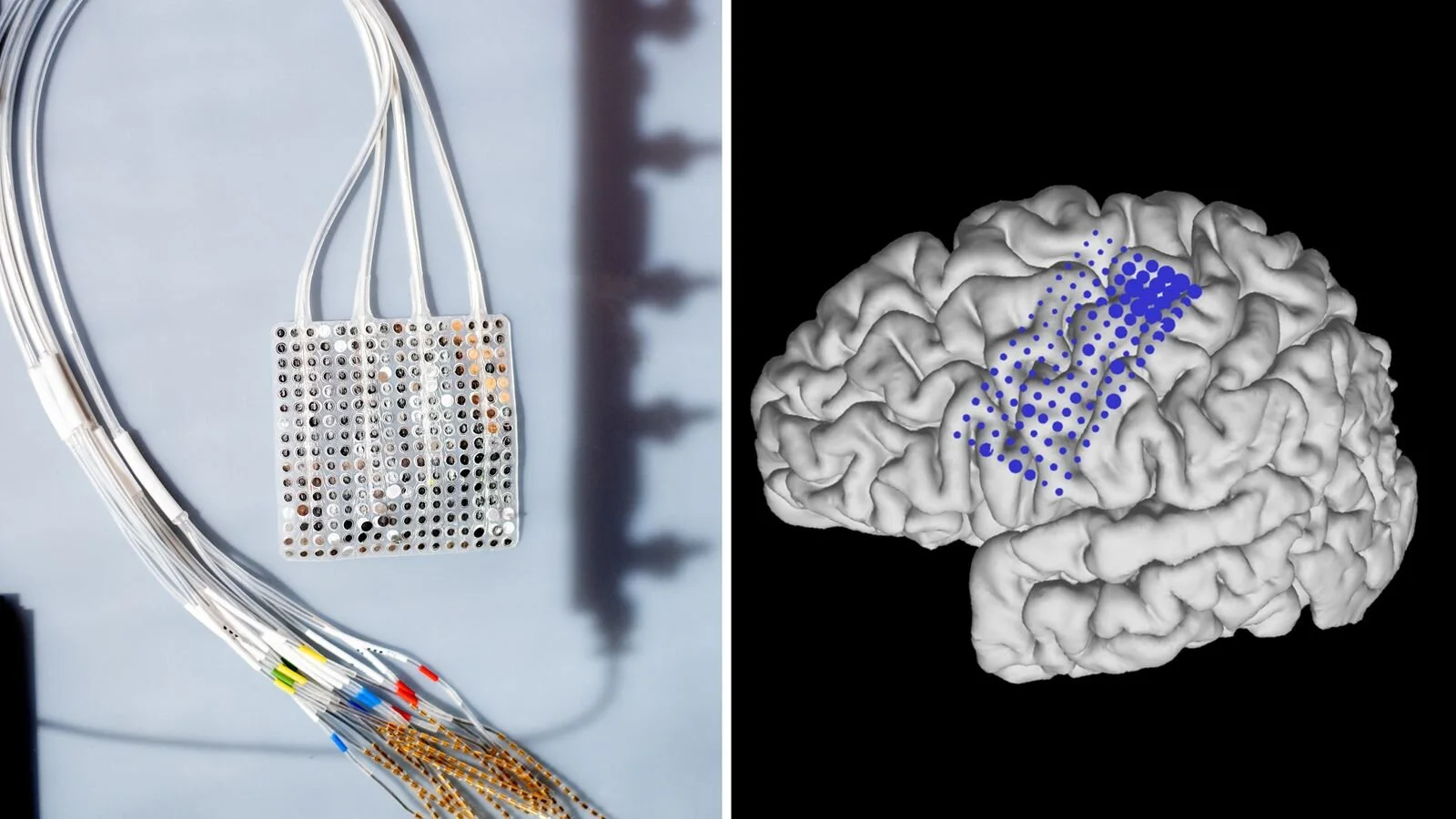 An array of electrodes are placed on the surface of the brain. Photo: UCSF/SkyNews