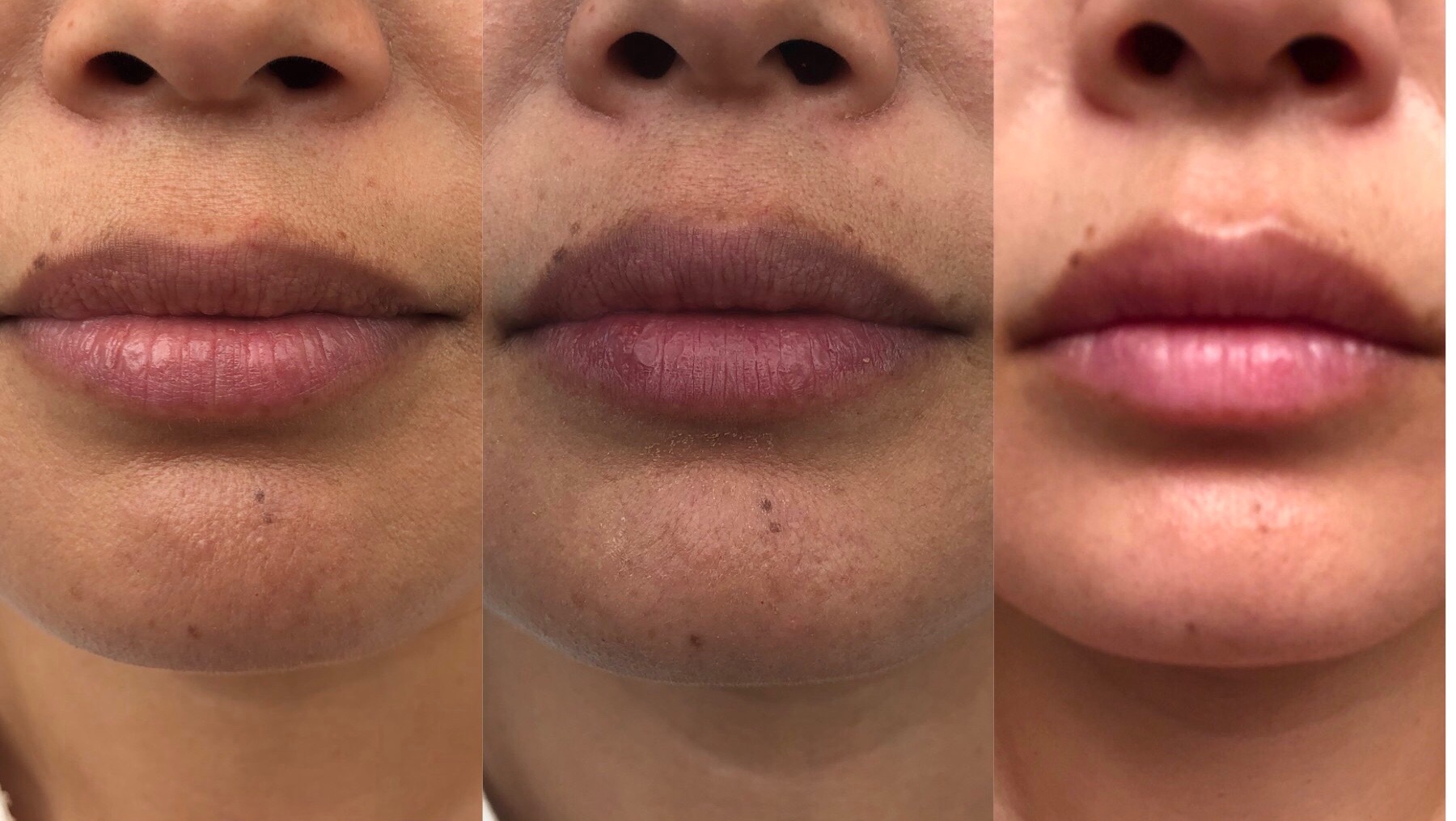 HyaPen lips, before after & 2 days post Tx, 7.31.2019.JPG