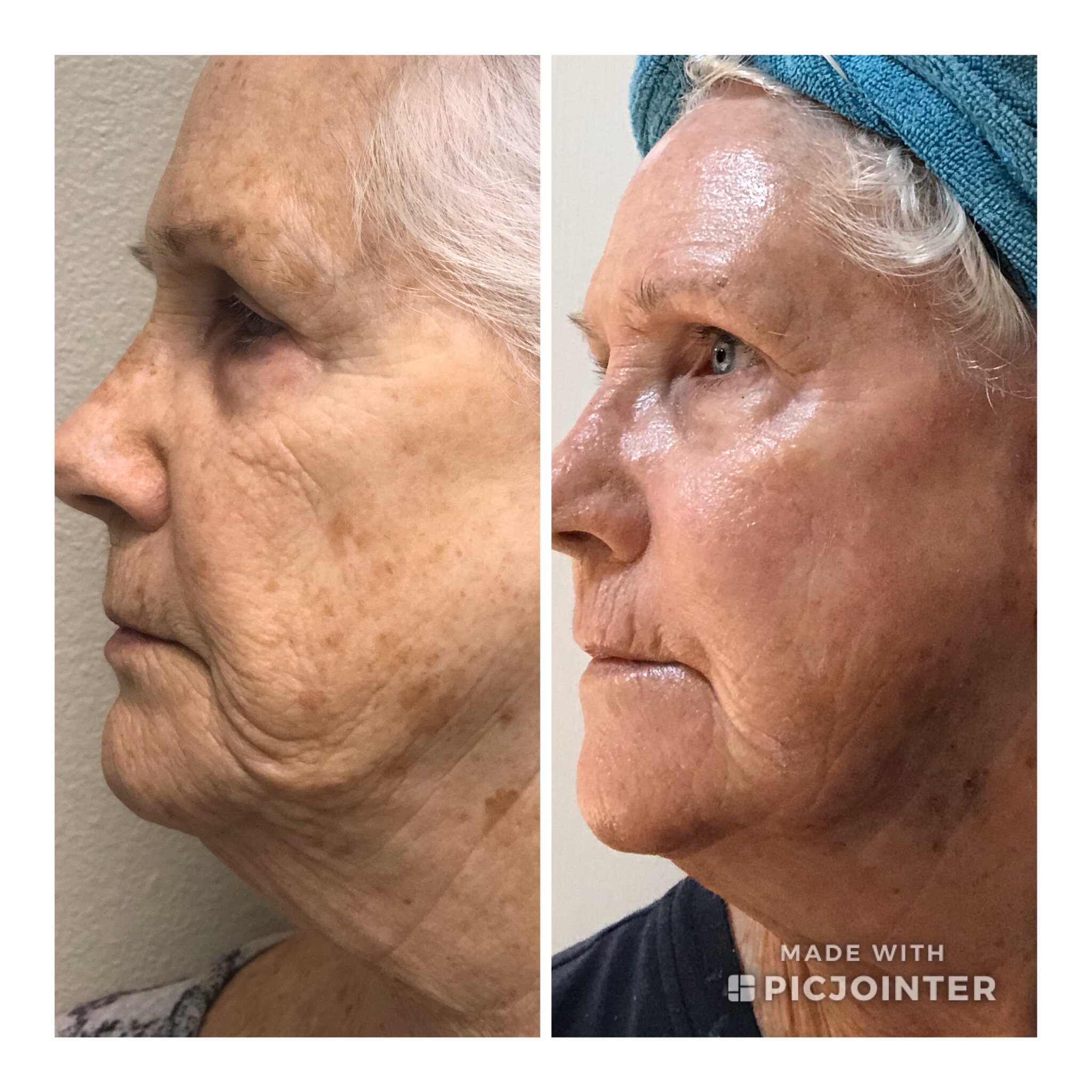 SmartSkin C02 Laser - Prescott, AZ - SkinPlus MedSpa