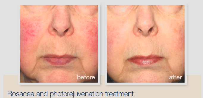 before and after IPL treatment for rosacea