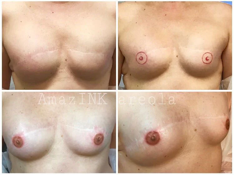 Areola-2.jpg