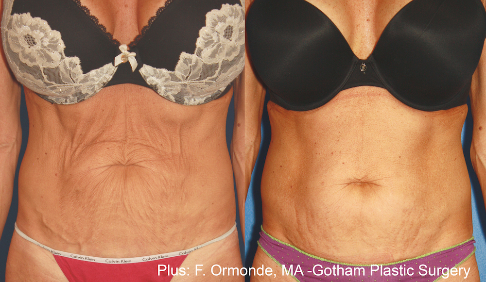 FO_Plus_1a_8weeks_1to2weeksapart_60mj_cutoff43_10to12mineachtreatment.jpg