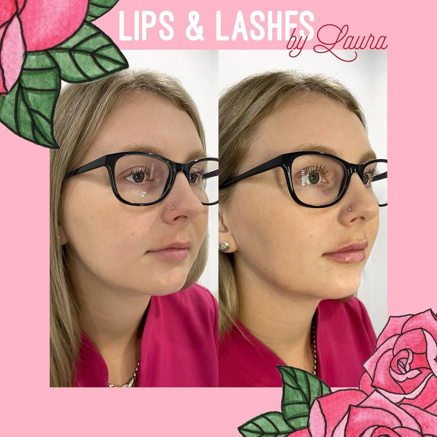 @coastalskinandlasernoosa are offering up to 1ml of soft, lush, long lasting lip filler with a vial of lash growth serum by EyEnvy for $535. Offer is available for the month of March only.

Above: Client before and immediately after .75ml of filler to the lips.

All cosmetic injectable treatments are conducted in medical clinic @coastalskinandlasernoosa under Dr Andrew Spall. Coastal Skin &amp; Laser reserve all rights to terms and conditions of offers which may change without notice, visit coastalskinandlaser.com.au for details. A consultation is always required to determine if a treatment is right for you, book online/link in bio xx