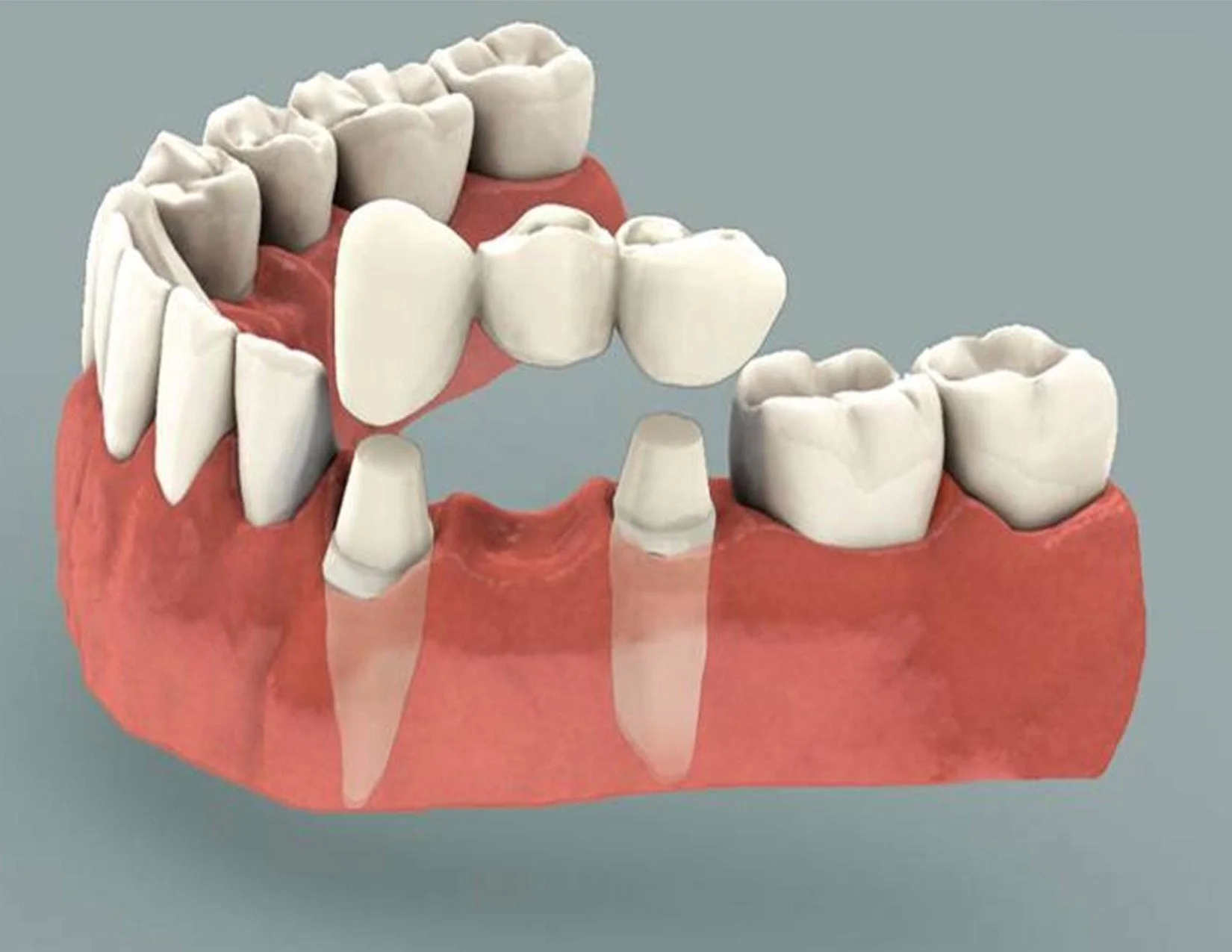 Restore your beautiful smile with a dental bridge