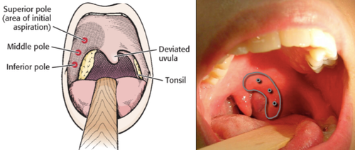 All you need to know about peritonsillar abscess — Covington Smiles