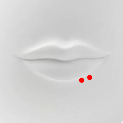 Spider Bites Piercing A spider bites piercing is actually two separate piercings that are placed near each other off to one side of the lower liparea.