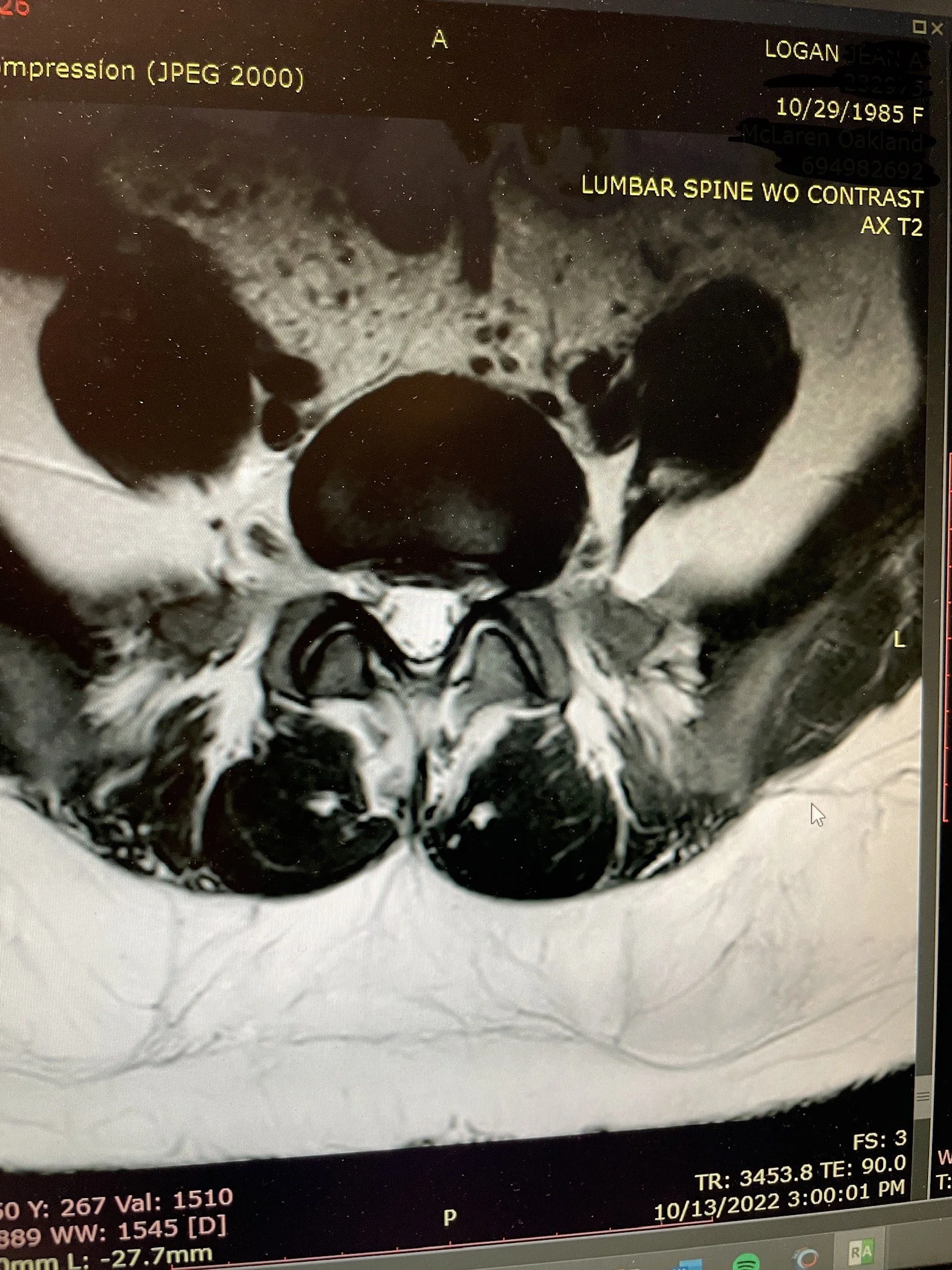 Can I Trade in My Spine?