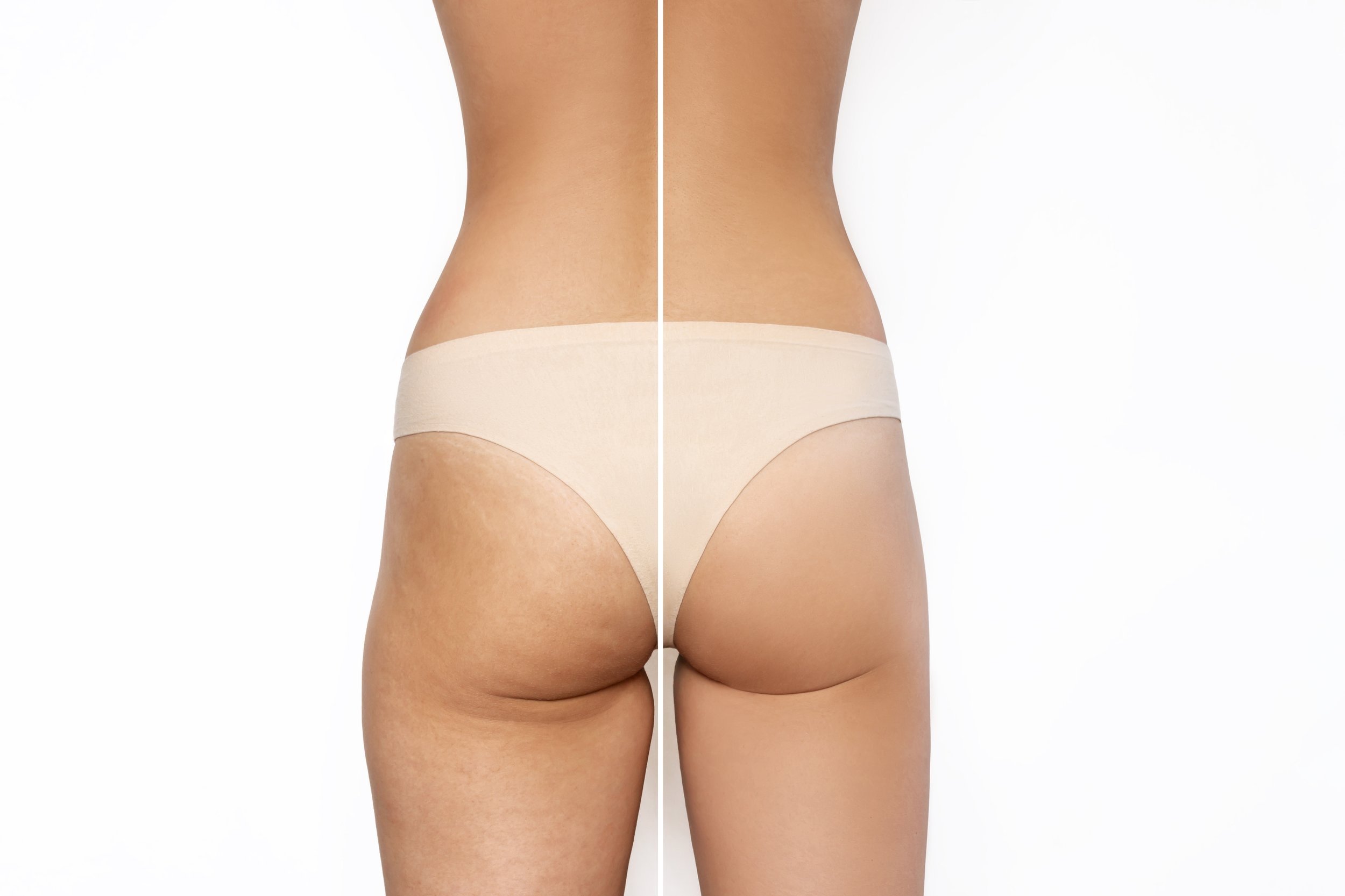 female-buttocks-before-after-liposuction-anticellulite-treatment-healthy-nutrition-training.jpg