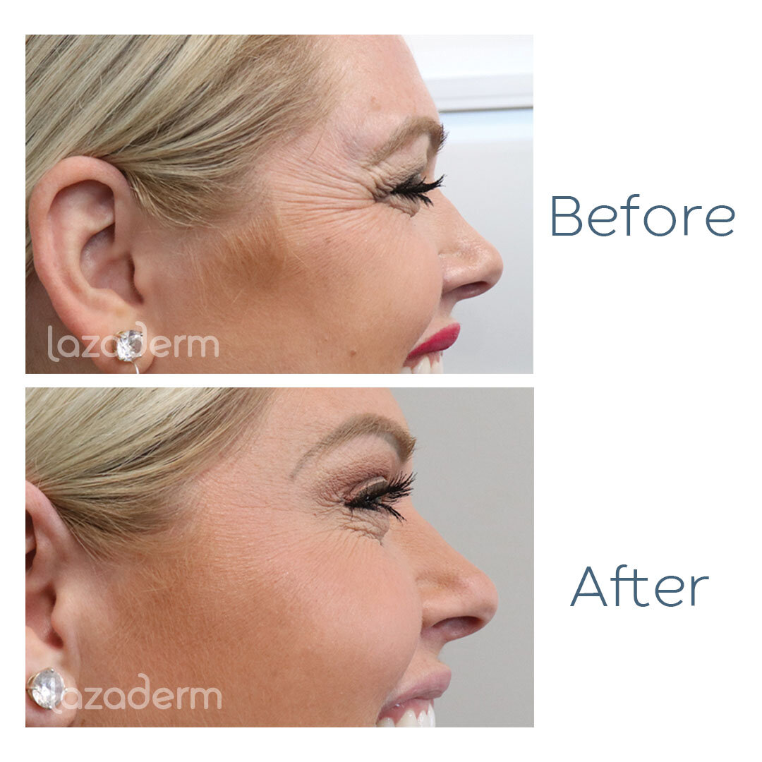 Botox Before and After Pictures: Real Results from Real Patients