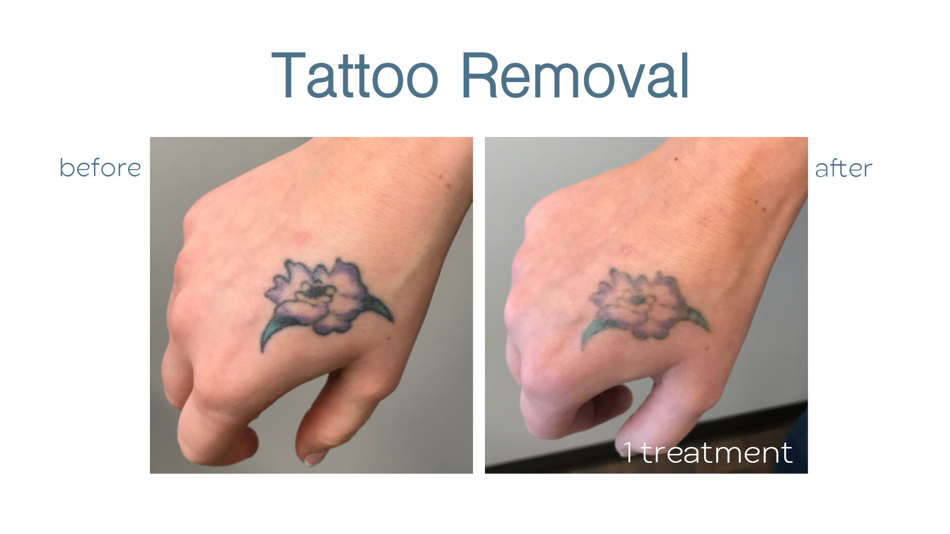 Share 95+ about tattoo removal near me super cool .vn