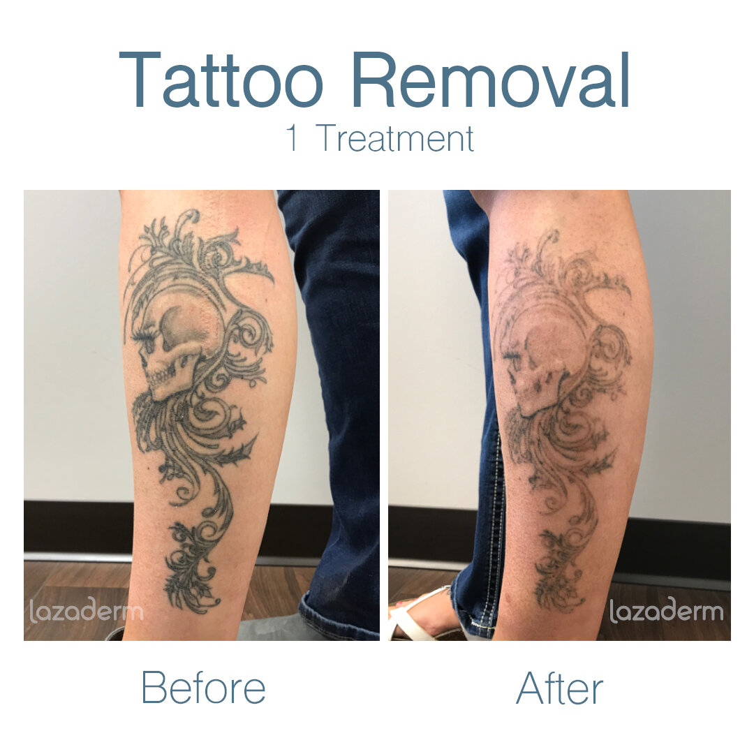 Laser Tattoo Removal in Chandler, AZ
