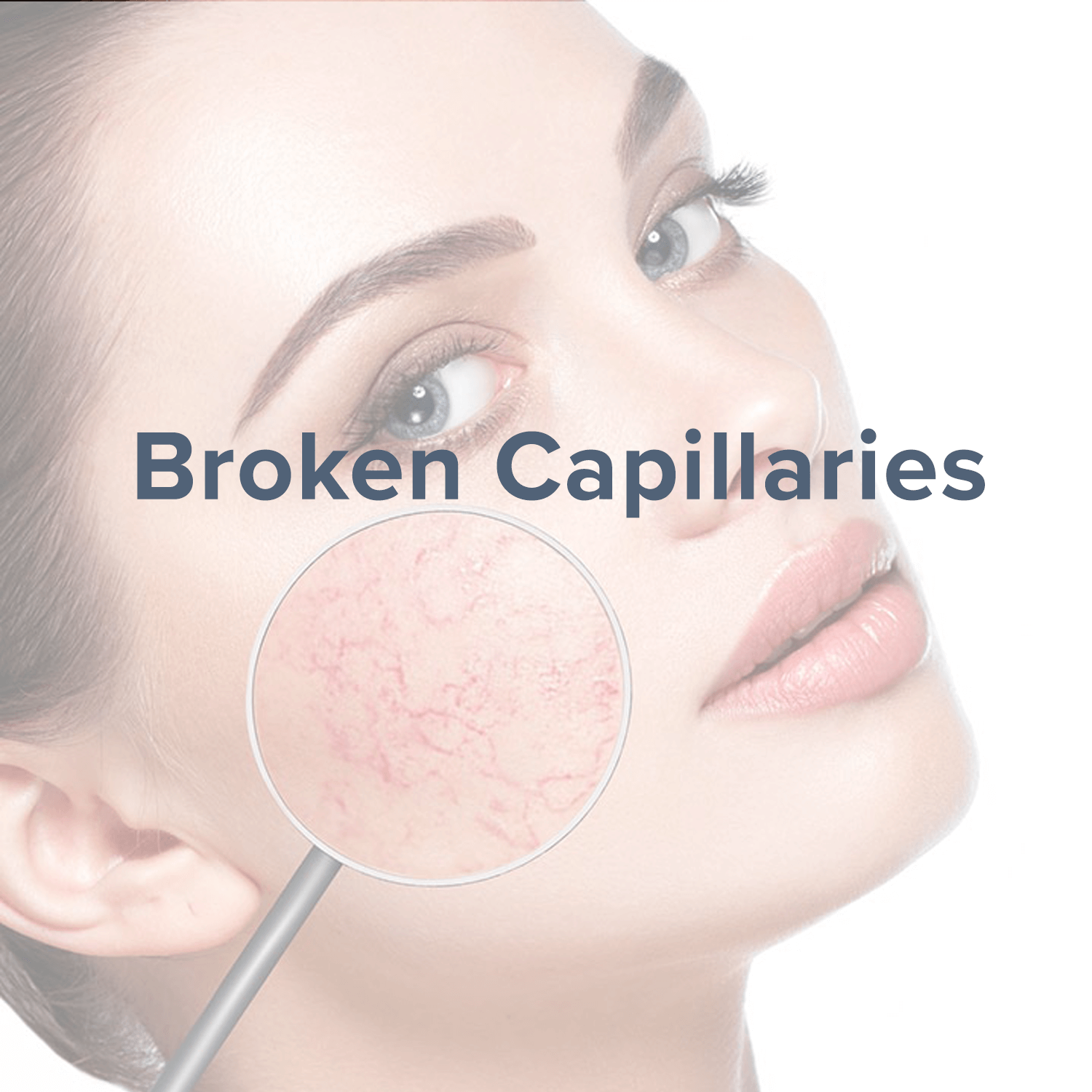 broken capillaries.png